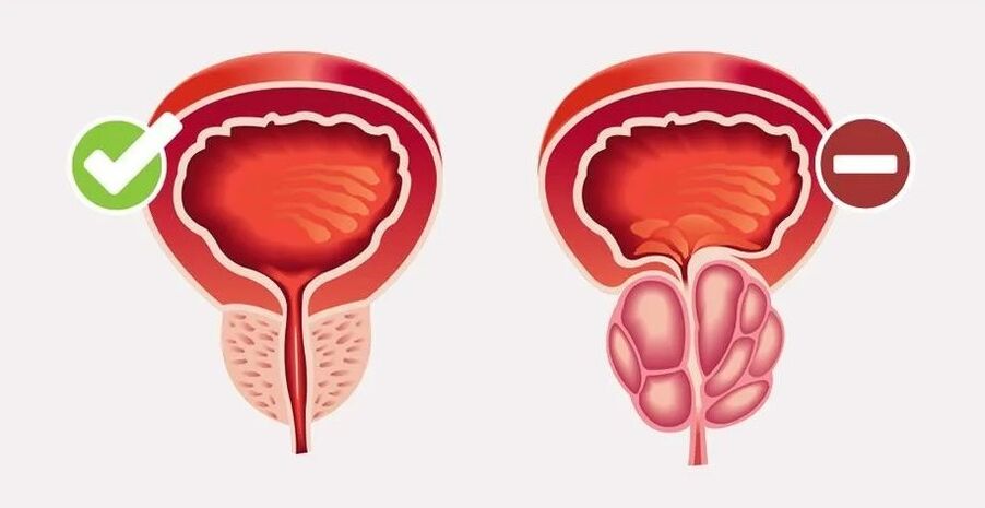 Prostatite chez les hommes
