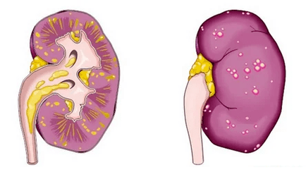 Qu'est-ce que la prostatite aiguë mène à