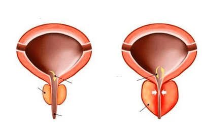Qu'est-ce que la prostatite aiguë
