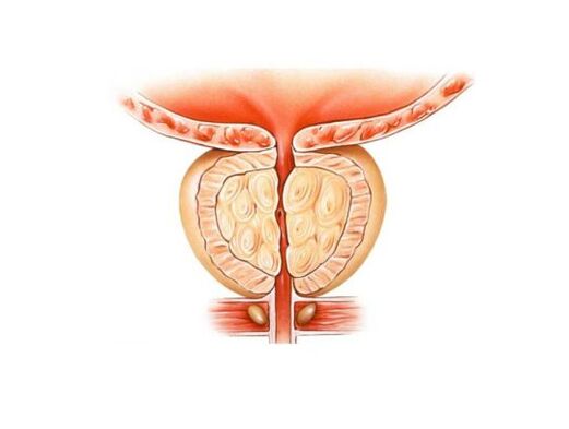 Augmentation de la prostate avec la prostatite