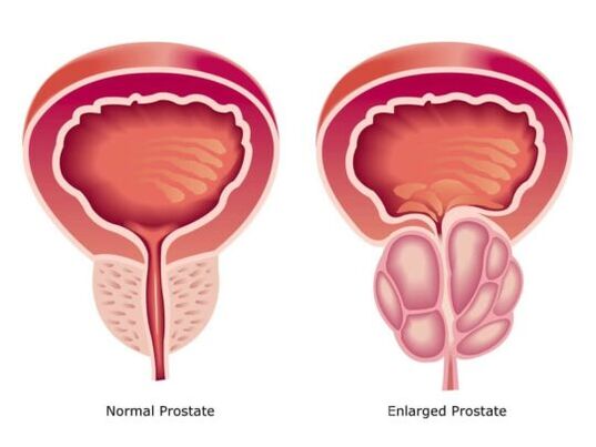 Prostate normal et élargi
