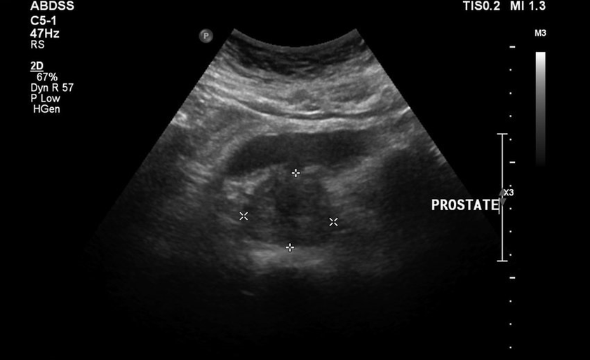 Échographie prostatite avant de prendre zxcvbnmqwert